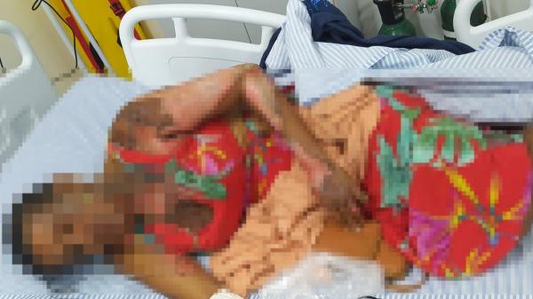 Mulher tem rosto e corpo queimados em tentativa de feminicídio em Maceió