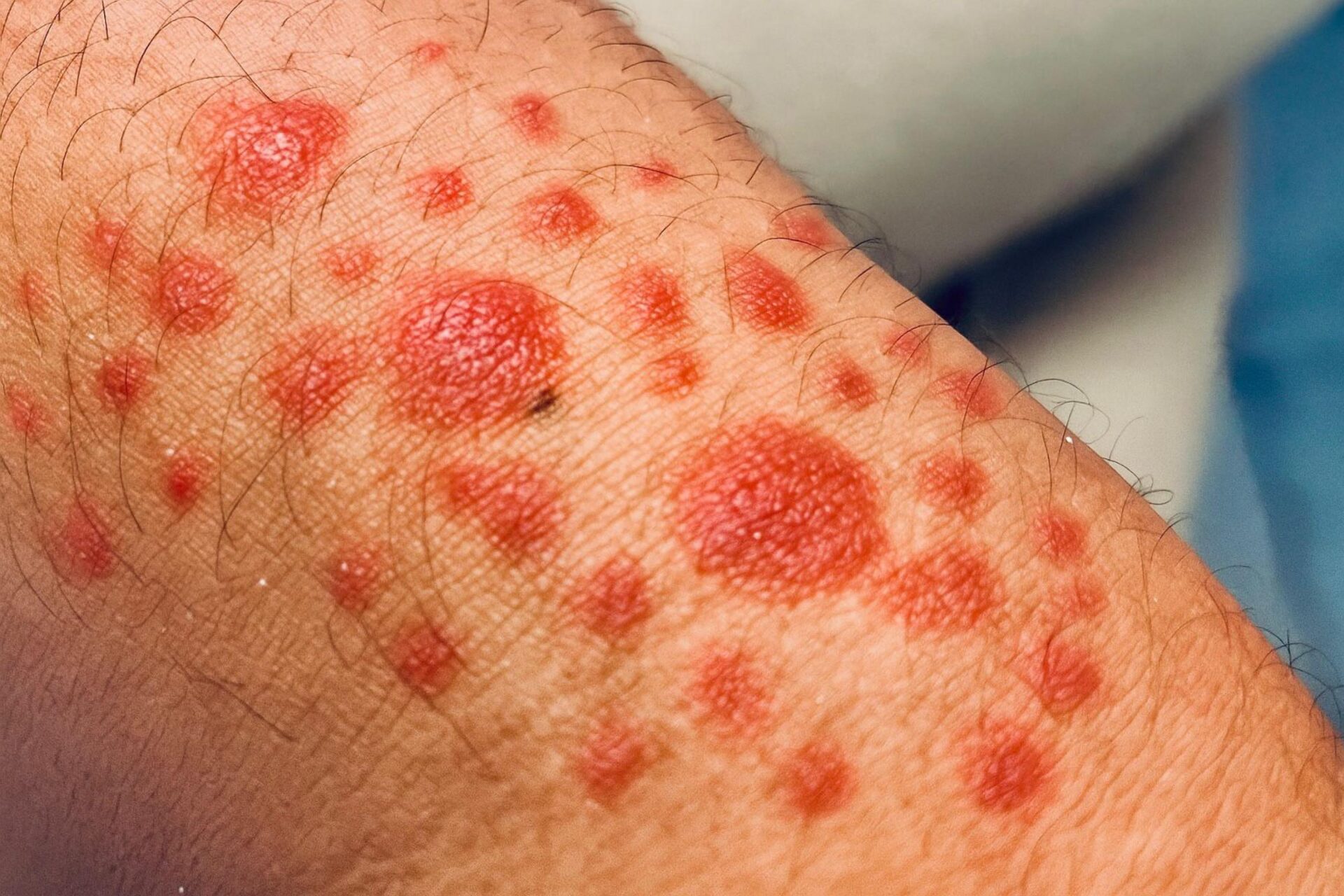 Anafilaxia pode comprometer diversos sistemas do corpo, respiratório, cardiovascular, gastrointestinal e cutâneo